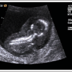 A black-and-white ultrasound image