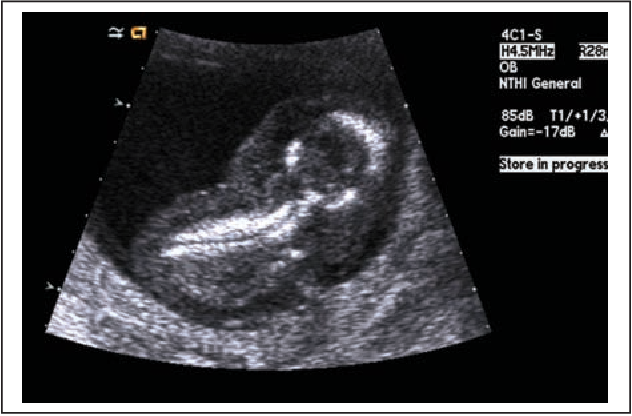 A black-and-white ultrasound image