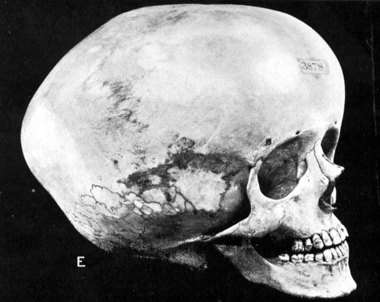 Skull deformity